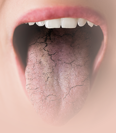 Dry Mouth: Symptoms, Causes, and Treatment