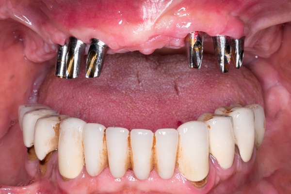 How Full Mouth Reconstruction Combines Function And Aesthetics