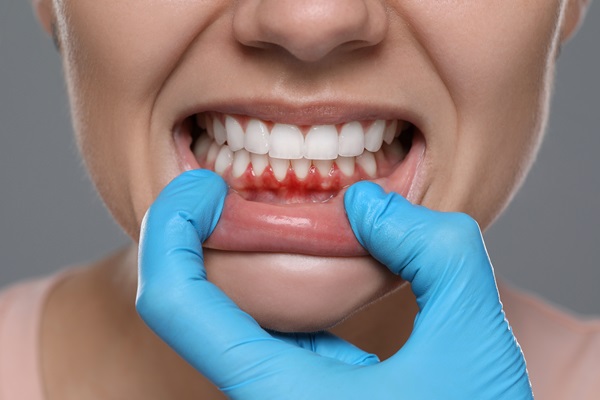 Benefits Of Gum Disease Treatment From A Dentist